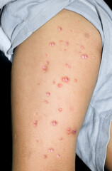 Monkeypox lesions in the thigh of Asian Child.