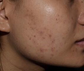 Acne, black spots and scars on face