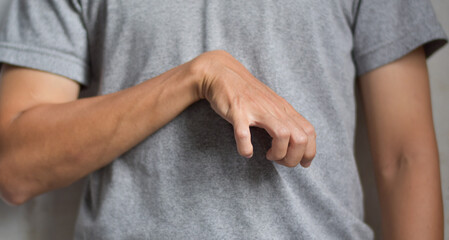 Volkmann’s contracture in Southeast Asian young man. - obrazy, fototapety, plakaty