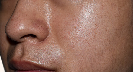 Oily face with wide pores of Southeast Asian, Myanmar or Korean adult man.
