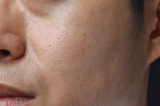 Fair skin with wide pores in face of Asian, Myanmar or Korean man.