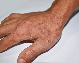 Fototapeta premium Itchy skin lesions in hand of Asian man. It may be caused by scabies infestation or fungal infection.