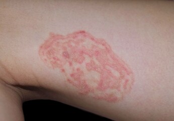 Fungal infection called tinea corporis in thigh of Asian child. Ringworm