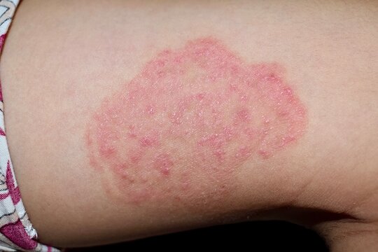 Fungal Infection Called Tinea Corporis in Leg. Widespread Ringworm Over  Knee Area Stock Photo - Image of dermatitis, lesion: 229678202