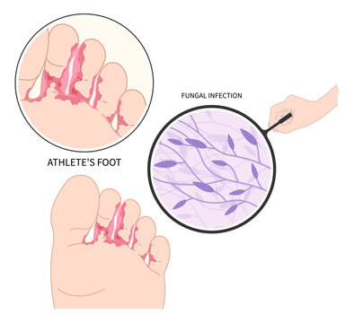 Foot Toe Itchiness With And Jock Itch Symptom Smell Bad Of Athlete's Pus Fungus Bacteria