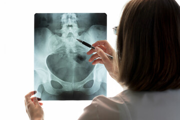 Female doctor holds and examines pelvic bones scan against background of light screen. Radiologist points to problem areas on X-ray.