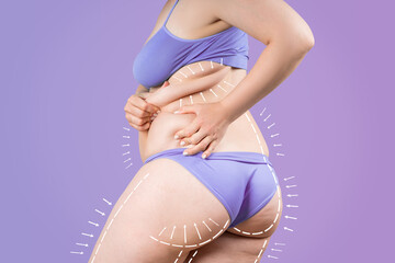 Buttocks, hip, back liposuction, fat and cellulite removal concept, overweight female body with...