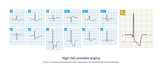 When a clockwise rotation of the basic ECG, the corresponding accuracy of the lead with the largest ST segment depression and the cardiac anatomy decreases during the attack of angina pectoris.