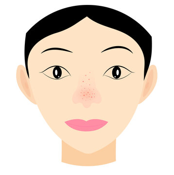 girl face with acne on the nose