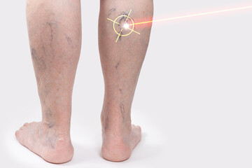 Varicosity and laser treatment. Close up of old legs of woman with vascular asterisks. Back view....