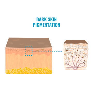 Melanin content and distribution in dark skin phototype. Pigmentation mechanism infographic diagram. Epidermis cross-section in closeup. Vector illustration.