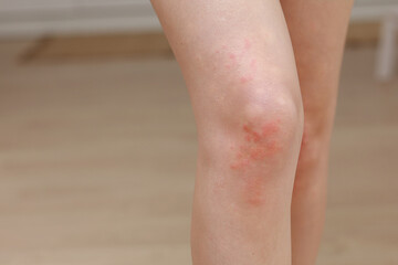 skin allergies, legs skin women. Closeup of red pustules on a knee, an allergic reaction caused by...
