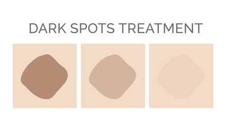 Dark Spots Removal Treatment Illustration