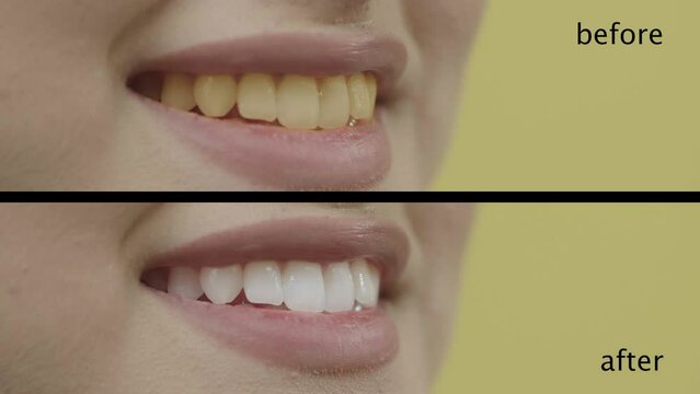 Dental care and dentistry concept. Close-up of happy Caucasian woman smiling at camera, showing white smile after teeth alignment procedure. Before after