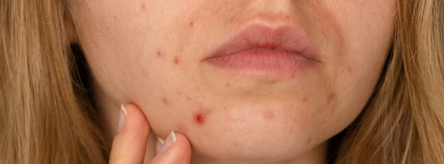 Unrecognizable woman showing her acne on face. Close-up acne on woman's face with rash skin ,scar...