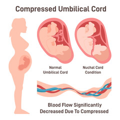 Compressed umbilical cord. Obstruction of blood flow through