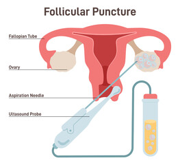 IVF. Follicular puncture, removing oocyte from the ovary of a woman
