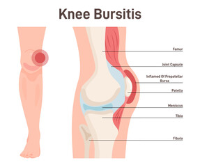 Bursitis. Knee joint inflammation. Inflamed or irritated bursae of synovial