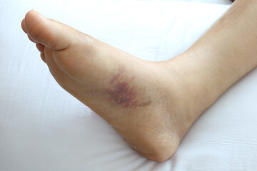 close up of women feet with swelling 