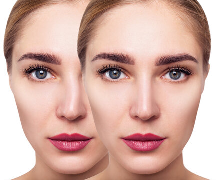Woman before and after nose plastic surgery.