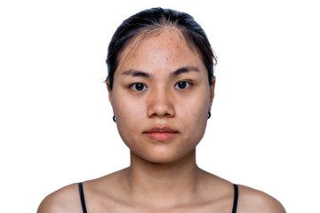 Young Asian woman worry about her face when she has problems with skin on her face in a natural background. Problems with acne and scar on the female skin. Problem skincare and health concept.