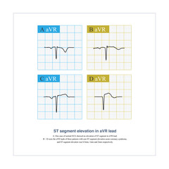 Generally, the amplitude of ST segment elevation of aVR lead ≥ 1mm is clinically significant, and it is often used for criminal vessel locationand prognosis interpretation of acute coronary syndrome.