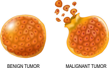 Cancer cells in Benign neoplasm and Malignant tumors. - obrazy, fototapety, plakaty