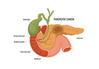 Pancreas cancer. Human cancer, medical illustration