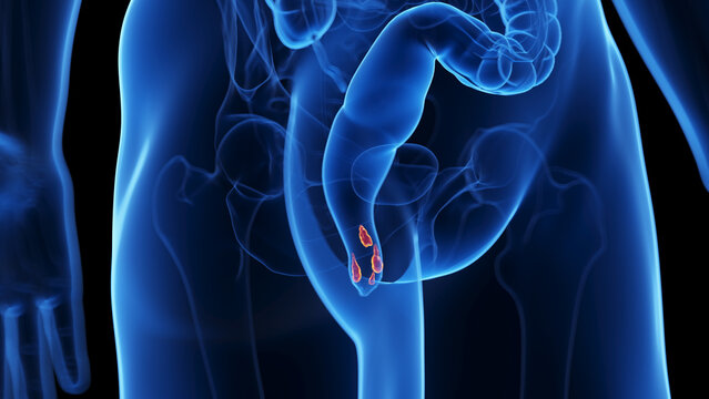 3d rendered medical illustration of hemorrhoids