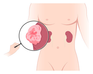 kidney cancer disease with Laparoscope donation minimally invasive surgery of Nephrectomy swelling organ artery tract stenosis