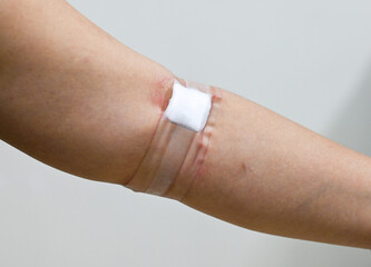 arm with bandage gauze tightly on it .