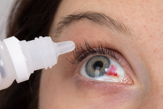 Woman with subconductival hemorrhage to the eye that the eye drops