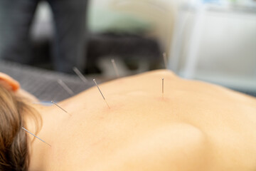 Obraz na płótnie Canvas Needles back procedure. Professional spa needle therapy.