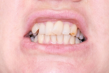 Adult woman teeth with malocclusion close up, orthodontic problem and preparing for treatment, crooked teeth before installing braces