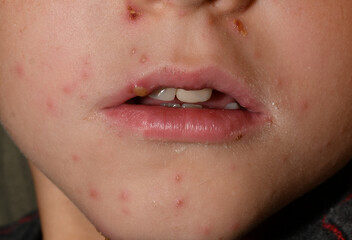Chickenpox rash on the face of a child. papules around the mouth.