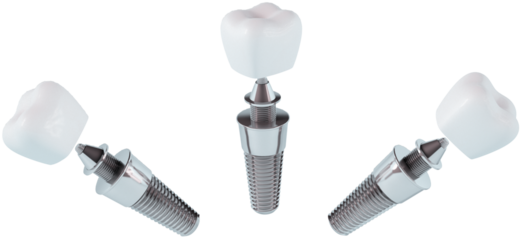 Dental implant