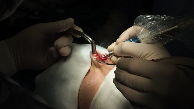 Crop doctors doing piezo rhinoplasty surgery