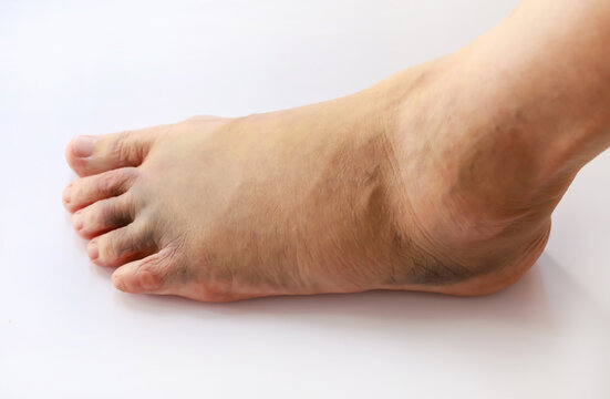 Left foot bruise or contusion and swollen cause by injury