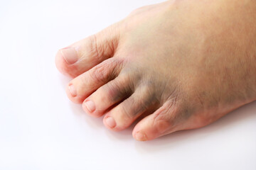 Left foot bruise or contusion and swollen cause by injury