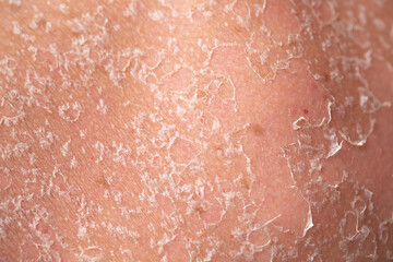 Sunburn, close-up of human skin. Flaky skin from allergies, peeling or eczema. Dry skin in need of treatment and hydration.