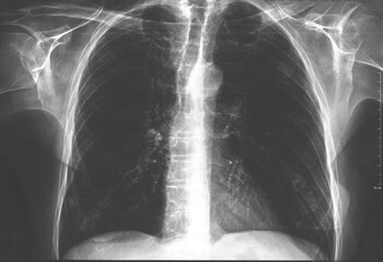 X-ray of the chest and lungs of a 72-year-old man.	