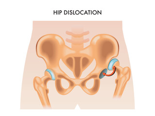 Medical illustration of the hip dislocation. - obrazy, fototapety, plakaty