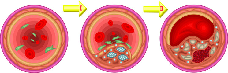動脈硬化　経過　イラスト