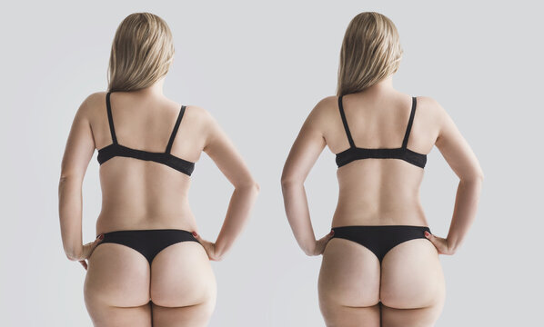 Woman's back before and after treatment. Curvature of the spine, one shoulder higher than the other scoliosis. Female figure in black underwear back unrecognizable. cellulite and overweight. plus size
