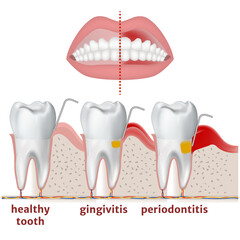 periodontitis and gingivitis. Diagram with disease of teeth and gums. Medical poster vector illustration - obrazy, fototapety, plakaty