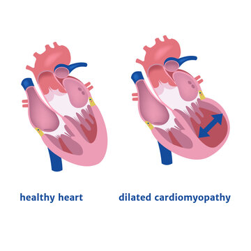 dilated cardiomyopathy. Expansion of the ventricle of the heart. Medical poster vector illustration