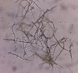 Microscopic fungi Malassezia furfur, showing yeast cells and hyphae. They are associated with dandruff, seborrhoeic dermatitis and tinea versicolor. Skin scraping for fungus.