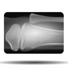 X-ray of the Knee Joint - Fla source file available - 
X-ray of the knee joints, an image of the knee bones on an X-ray. clear picture of the patient, fluid in the joint, musculoskeletal system