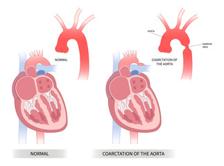 Heart coarctation of the aorta high blood pressure and Turner's disorder - obrazy, fototapety, plakaty