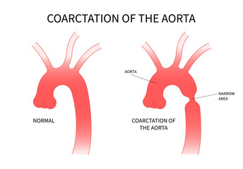 Heart coarctation of the aorta high blood pressure and Turner's disorder - obrazy, fototapety, plakaty